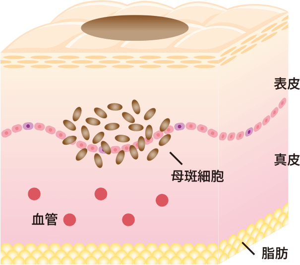 ほくろ｜診療内容｜慶應義塾大学病院美容医療サイト｜痩身、ほくろ、ニキビ跡治療